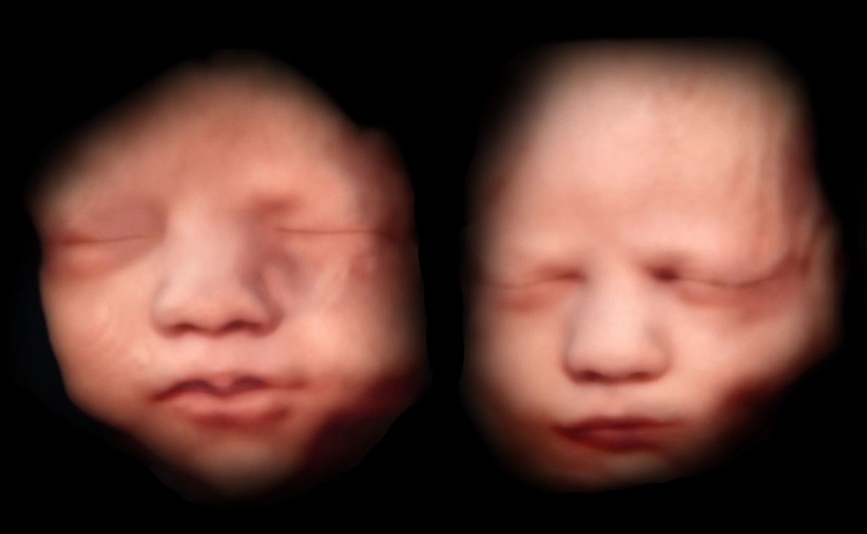 Baby Ultraschall Die 3D / 4D Ultraschall Hamburg, Baby Ultraschall